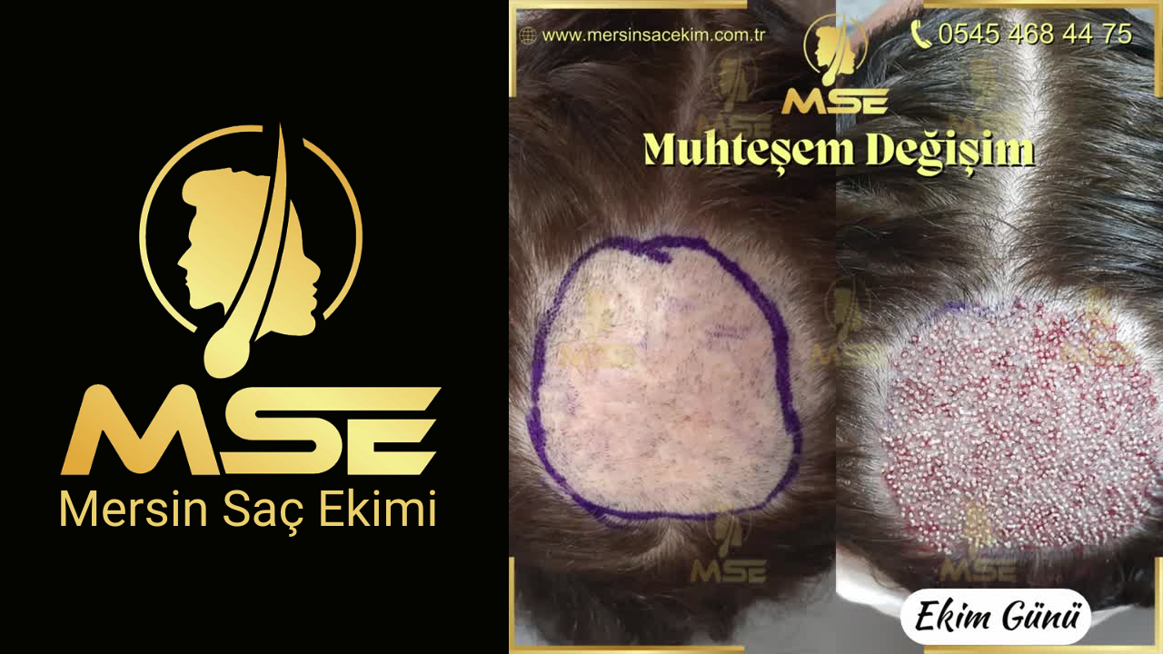 Mersin Saç Ekimi